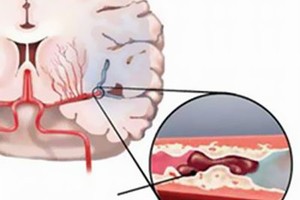 Đau nửa đầu vai gáy có phải thiếu máu não?