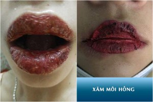 Hội chị em phun môi collagen, netizen nhìn mà chết khiếp