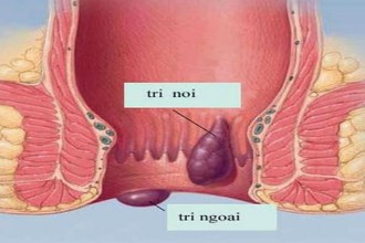 Với bài thuốc này, trĩ nội, trị ngoại đều khỏi hết