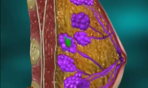Cách nhận biết sớm ung thư vú