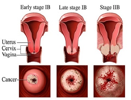Các biểu hiện thường gặp của bệnh ung thư cổ tử cung