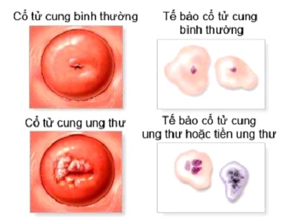 Ăn gì sau điều trị ung thư cổ tử cung?