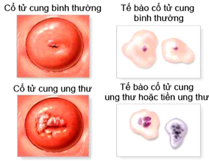 9 sự thật giật mình về ung thư cổ tử cung