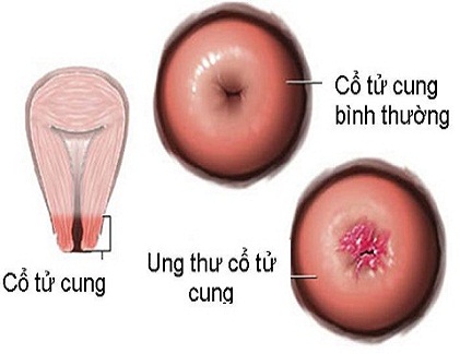 Các loại ung thư cổ tử cung phổ biến