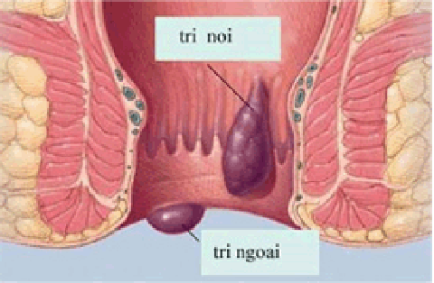 Hoại tử tầng sinh môn vì đắp thuốc chữa trĩ