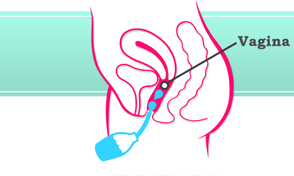 Đã có nhiều nghiên cứu chứng minh  thụt rửa vùng kín hoặc vệ sinh vùng kín bằng dụng cụ vệ sinh sẽ dẫn đến các nhiễm do nấm men, viêm khung xương chậu và mang thai ngoài tử cung. Các nhà nghiên cứu còn phát hiện ra mối liên hệ giữa thụt rửa vùng kín với ung thư buồng trứng, giảm khả năng sinh sản, HIV và một số bệnh lây nhiễm qua đường tình dục khác.  