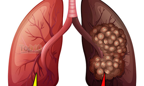 Những dấu hiệu cho thấy bạn đã bị ung thư phổi