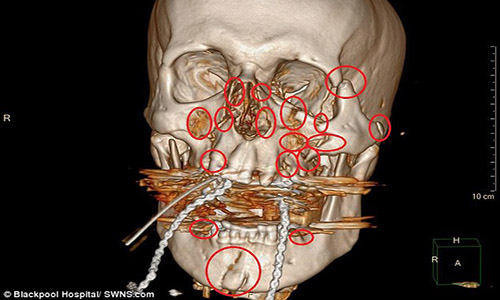 Khuôn mặt được vá 13 miếng kim loại và 52 đinh vít