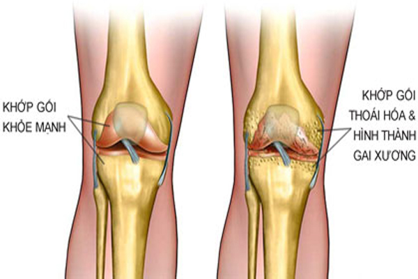 8 cách giảm cơn đau khớp gối hữu hiệu