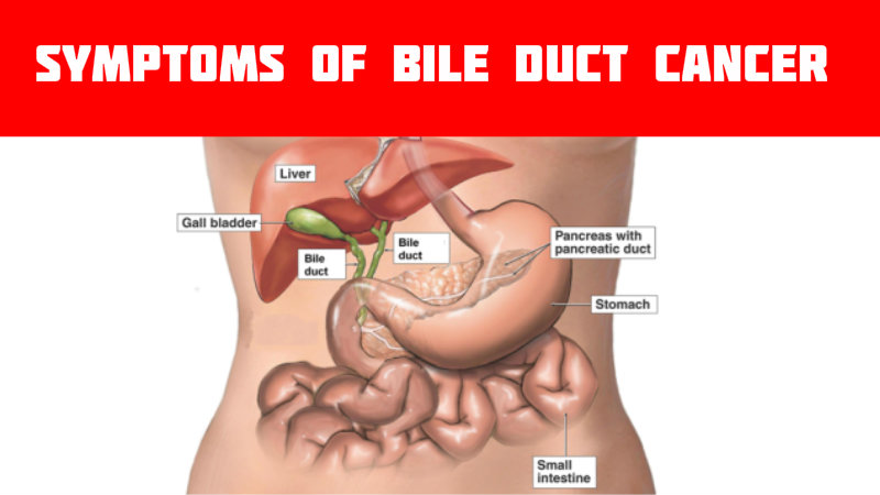 Dễ bị ung thư ống dẫn mật nếu có triệu chứng này