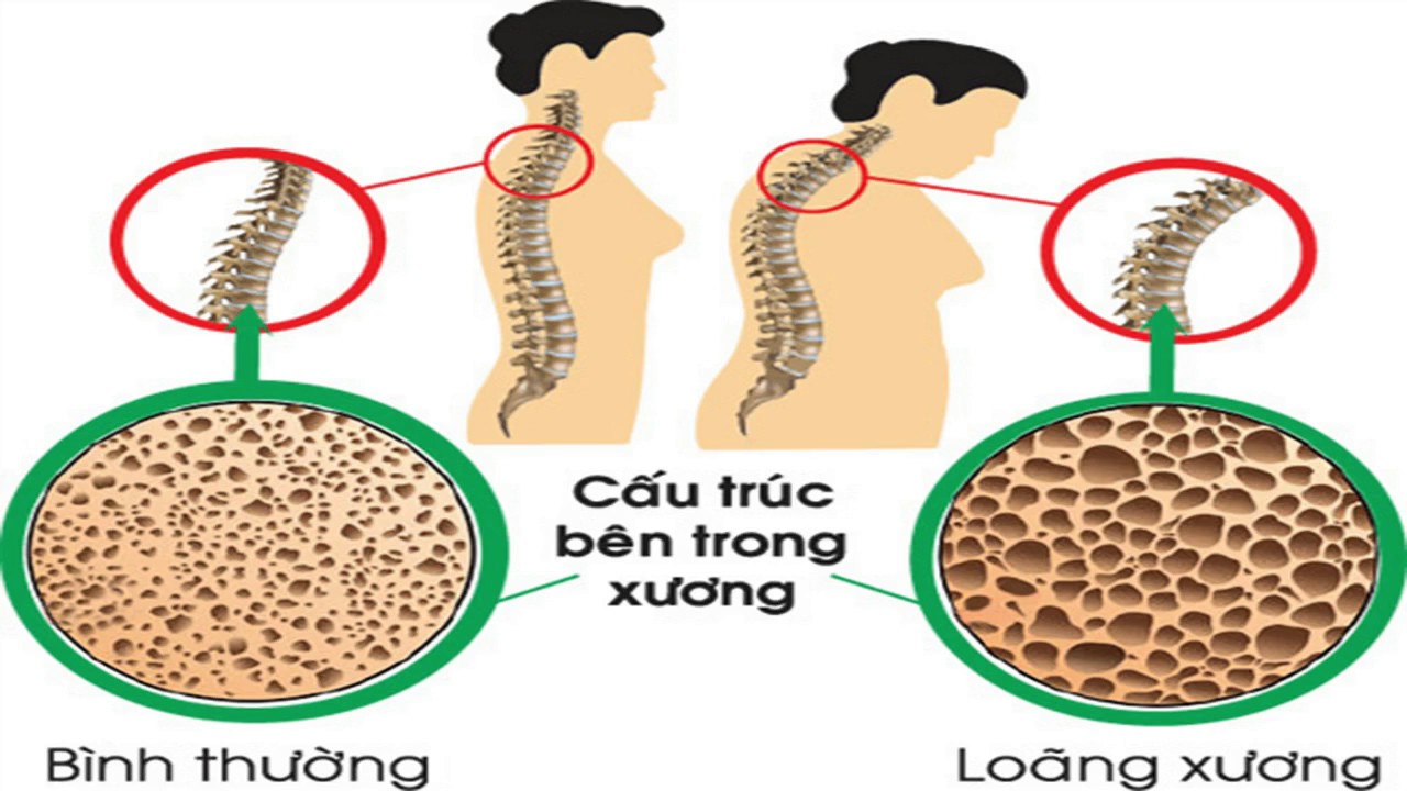 Những thói quen khi trẻ khiến chưa già đã loãng xương