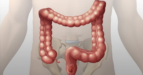 Cách thải độc đường ruột cấp tốc, ai cũng làm được