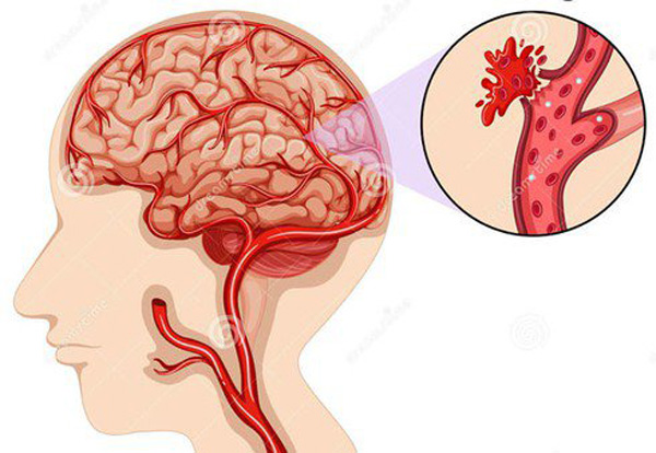 Dấu hiệu cảnh báo xuất huyết não - “kẻ giết người nhanh nhất”