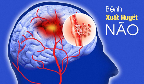 Loạt biểu hiện không ngờ là dấu hiệu xuất huyết não