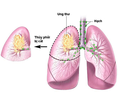 Giúp người ung thư phổi tự tin với chuyện vợ chồng