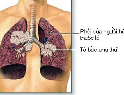 Bí quyết đơn giản giúp tránh xa ung thư phổi