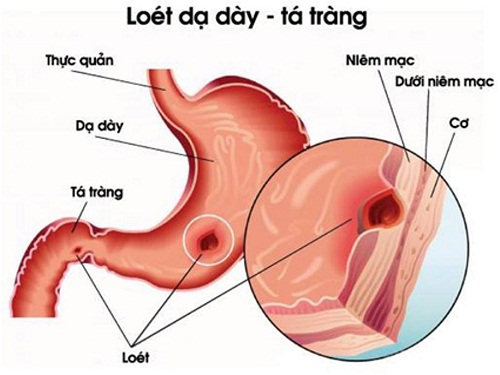 Nguy cơ sức khỏe từ trào lưu mì cay 7 cấp độ