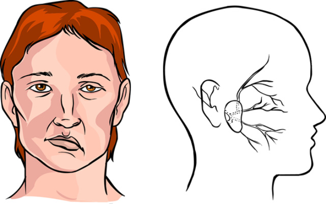 Cách xử lý khi bị cấm khẩu, méo miệng do trúng gió