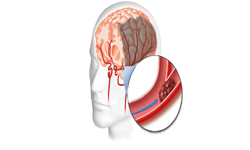 Các yếu tố nguy cơ dẫn đến thiếu máu não 