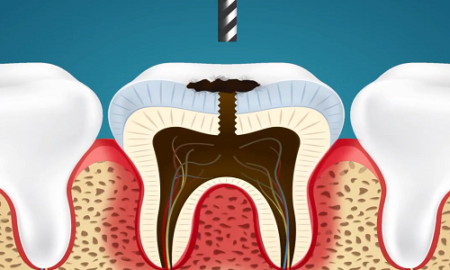 Xem cách nha sĩ nhổ răng sâu
