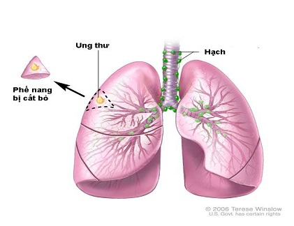 Dấu hiệu bạn bị ung thư phổi