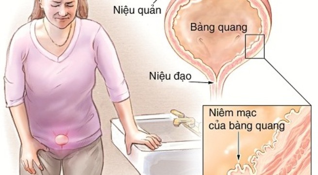 12 bài thuốc hỗ trợ điều trị viêm bàng quang cực hiệu quả