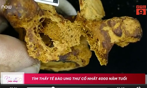 Video: Tìm thấy tế bào ung thư cổ nhất 4000 năm tuổi