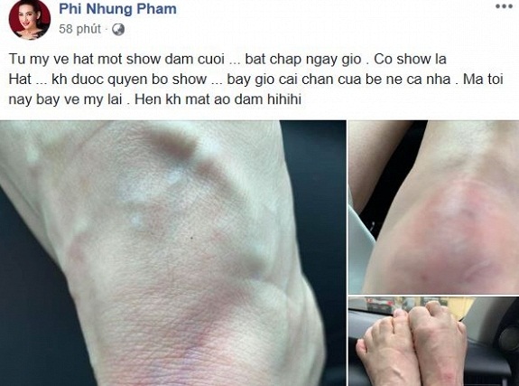 Phi Nhung bị ngã bầm tím chân vì vội vã chạy show