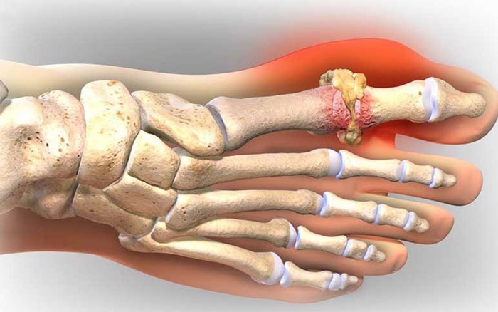 Những đồ ăn làm giảm cơn đau của người bệnh gout