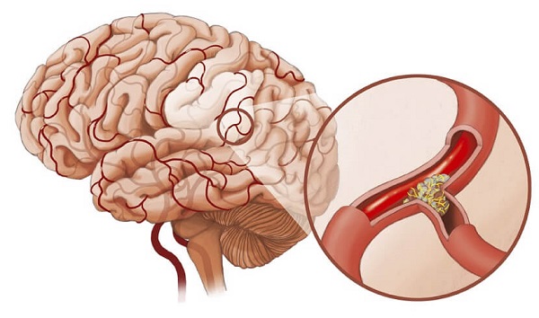 Phi công huyền thoại Nguyễn Văn Bảy qua đời vì xuất huyết não: Cách phòng ngừa bệnh?