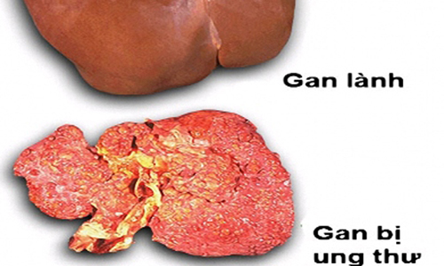 Mách bạn cách ngăn ngừa ung thư gan hữu hiệu