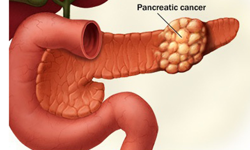 Dấu hiệu chứng tỏ bạn mắc ung thư tuyến tụy