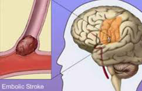 Những yếu tố hàng đầu gây thiếu máu não