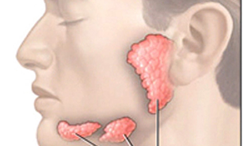 Dấu hiệu thường gặp của ung thư tuyến nước bọt