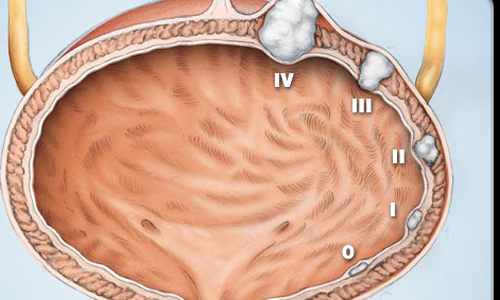 Sự tàn phá khủng khiếp của ung thư bàng quang