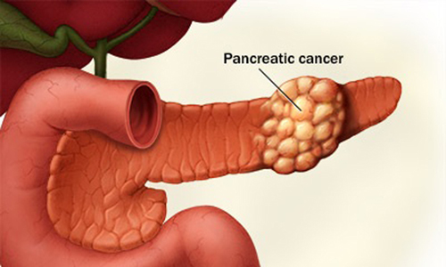 Thực phẩm gây ung thư tuyến tụy nên tránh xa