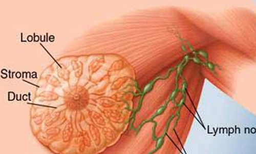 Hiểu lầm ngớ ngẩn về nguyên nhân ung thư vú