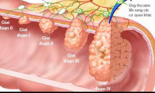 Nhận diện ung thư dạ dày theo từng giai đoạn