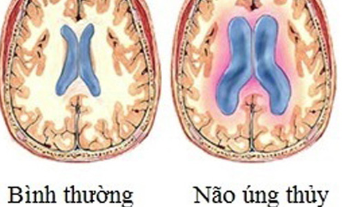 Bí ẩn căn bệnh não úng thủy của Quốc vương Thái Lan