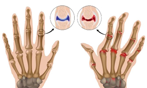 7 hiểu lầm chết người về bệnh viêm khớp dạng thấp