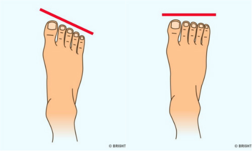 Hình dáng bàn chân tiết lộ điều gì về bạn?