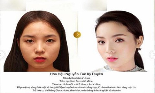 Lộ ảnh “tố cáo” hoa hậu Kỳ Duyên phẫu thuật thẩm mỹ khó phủ nhận