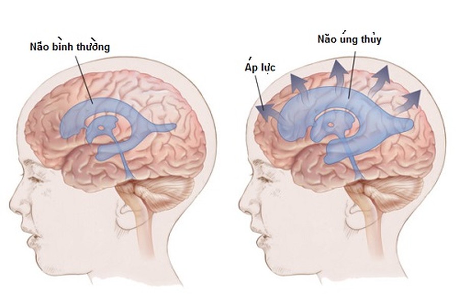 Não úng thủy hay mềm nhũ não không phải là một bệnh lý riêng biệt mà đúng hơn đó là hậu quả của một nhóm các bệnh lý khác nhau nhưng cùng có chung một đặc trưng là suy giảm lưu thông hoặc hấp thu dịch não tủy. .