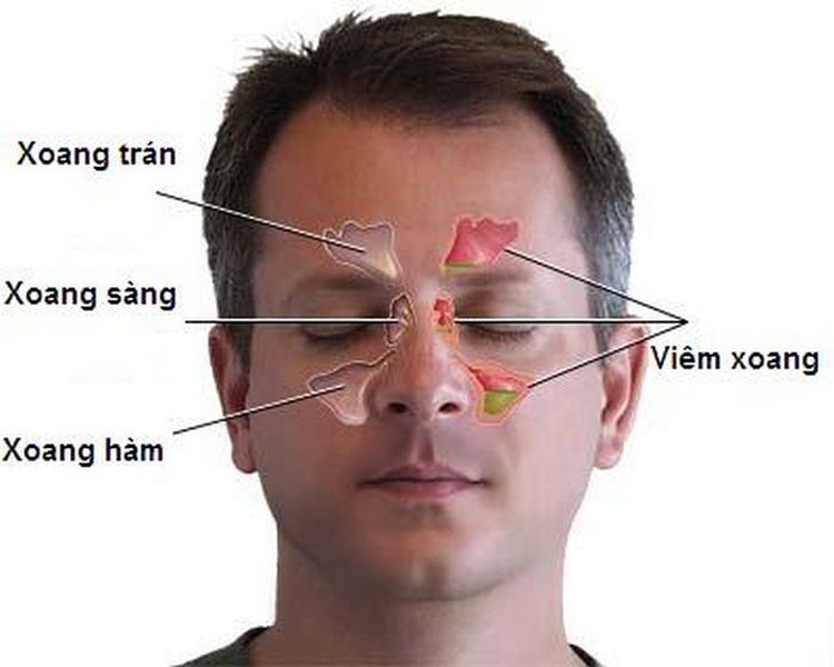 Viêm xoang là một bệnh xảy ra do viêm các xoang cạnh mũi. Nguyên nhân gây bệnh có thể do môi trường chứa nhiều vi khuẩn, vi khuẩn vào mũi gây viêm. Bệnh xoang không phải là vấn đề sức khỏe nghiêm trọng nhưng nó làm người bệnh sinh hoạt khó khăn, nhất là vào mùa lạnh. Các bạn có thể áp dụng các  bài thuốc chữa viêm xoang từ các loại hạt sau. Ảnh: Bepmonngon.