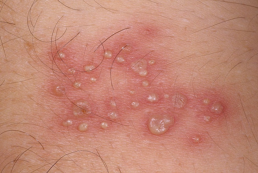 Zona (giời leo) do vi-rút herpes zoster, còn gọi là varicella-zoster gây ra và đây cũng là loại vi-rút gây ra bệnh thủy đậu. Ảnh: chuyenkhoadalieu.net.