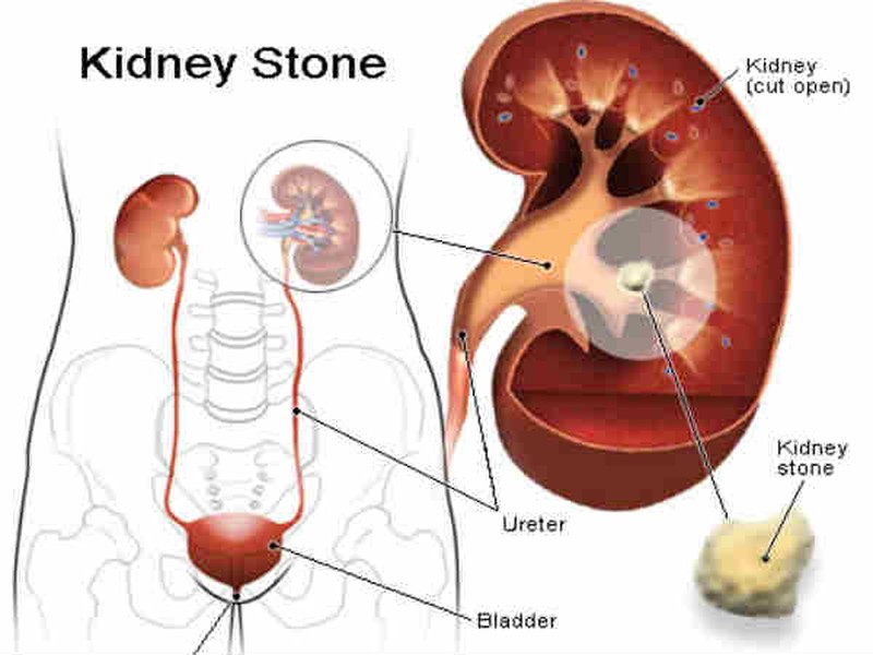 Thận được tạo thành từ hàng triệu tế bào nhỏ xíu được gọi là nephrons. Chúng là những chất lọc máu không tinh khiết xâm nhập vào thận. Sau đó máu sẽ được làm sạch và trở lại cơ thể để lưu thông. Do đó, thận là cơ quan rất quan trọng đối với hoạt động của cơ thể. Nếu bạn đang bị sỏi thận, hãy tham khảo một số biện pháp khắc phục tự nhiên để  loại bỏ sỏi thận thay vì phẫu thuật. Ảnh: Boldsky.