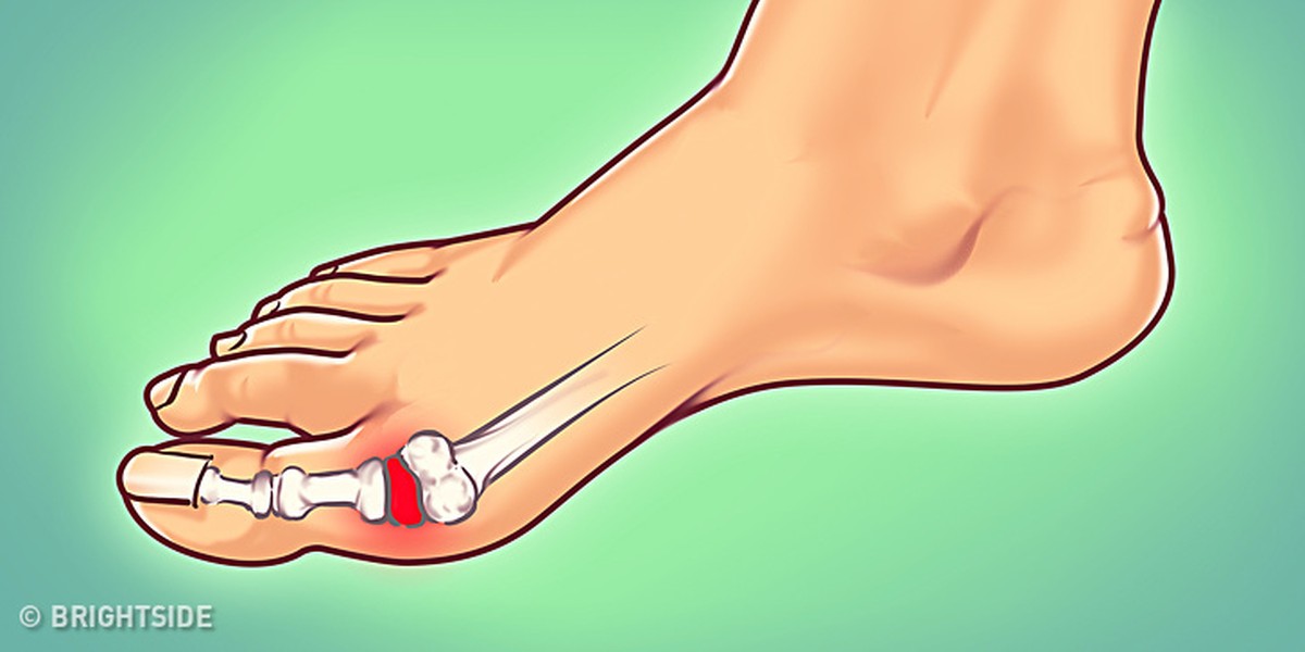 Gout có thể hiểu một cách rất đơn giản là chứng sưng khớp - thường xảy ra ở ngón chân cái, do lượng acid uric trong máu tăng cao. Nghe có vẻ đơn giản nhưng việc khớp sưng đỏ lên đi kèm với những cơn đau thực sự khủng khiếp.