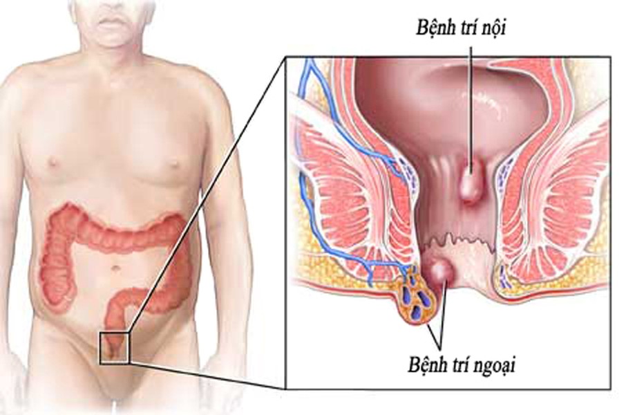 Tùy vào vị trí búi trĩ mà người bệnh đối diện với những biểu hiện khác nhau. Dù vậy, hiện tượng chảy máu khi đại tiện được xem là dấu hiệu phổ biến nhất. Đối với trĩ nội, ở giai đoạn đầu, niêm mạc phía trong thiếu các sợi thần kinh cảm giác đau nên thường không gây khó chịu. Bạn chỉ có thể phát hiện hiện tượng chảy máu qua màu đỏ tươi trên giấy vệ sinh hoặc bồn cầu.