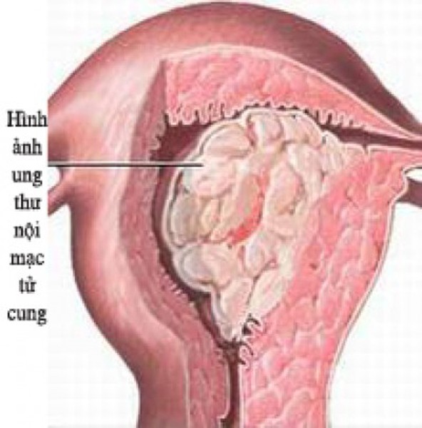 U nội mạc tử cung là loại ung thư gây tử vong phổ biến thứ năm ở phụ nữ. Giống như nhiều loại ung thư khác, các nhà khoa học chưa tìm ra nguyên nhân chính xác gây bệnh. Dù vậy bằng cách hấp thụ flavonoid có nhiều trong trà, bạn có khả năng ngăn ngừa đáng kể nguy cơ mắc bệnh.