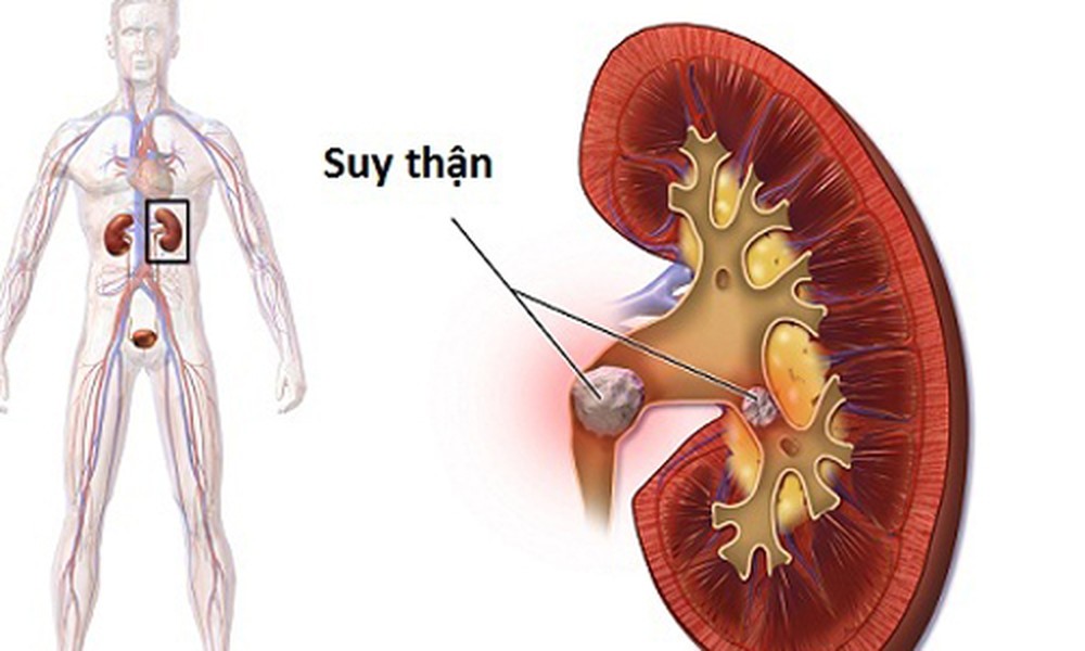 Các vấn đề về thận được xem là một trong những "sát thủ thầm lặng" đe dọa sức khỏe. Hầu hết bệnh nhân bị suy giảm chức năng thận thường không có  dấu hiệu bệnh thận trong giai đoạn đầu. Tuy nhiên, chức năng thận không làm việc đúng cách sẽ khiến độc tố tích tụ trong cơ thể.